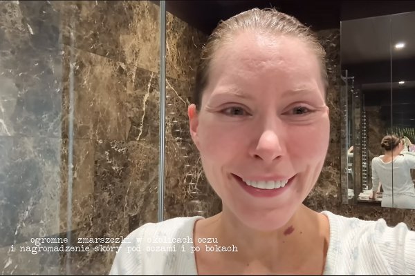 Julia von Stein i dramat po liftingu twarzy. Efekty, żal i odpowiedź lekarza
