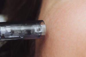 Co to jest efekt fakira w mezoterapii mikroigłowej?